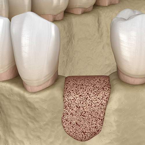 Chirurgie pré implantaire Dr Ephraïm Fareau Dentiste Haguenau