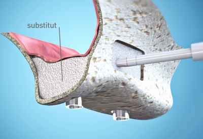 Sinus Lift - Cabinet dentaire Dr Ephraim Fareau - Chirurgien dentiste Haguenau - Dentiste Haguenau