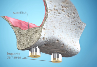 Sinus Lift - Cabinet dentaire Dr Ephraim Fareau - Chirurgien dentiste Haguenau - Dentiste Haguenau