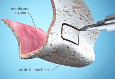 Sinus Lift - Cabinet dentaire Dr Ephraim Fareau - Chirurgien dentiste Haguenau - Dentiste Haguenau