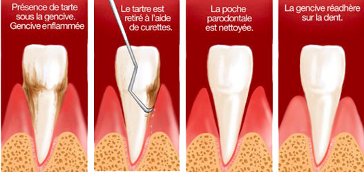 Surfaçage radiculaire - Cabinet dentaire Dr Ephraim Fareau - Chirurgien dentiste Haguenau - Dentiste Haguenau