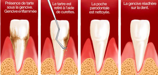 Surfaçage radiculaire - Cabinet dentaire Dr Fareau - Dentiste Haguenau