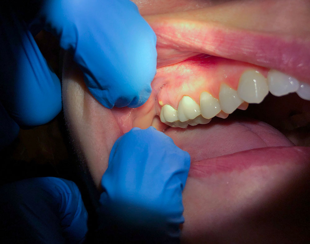 Abcès parodontale - Cabinet dentaire Dr Ephraim Fareau - Chirurgien dentiste Haguenau - Dentiste Haguenau