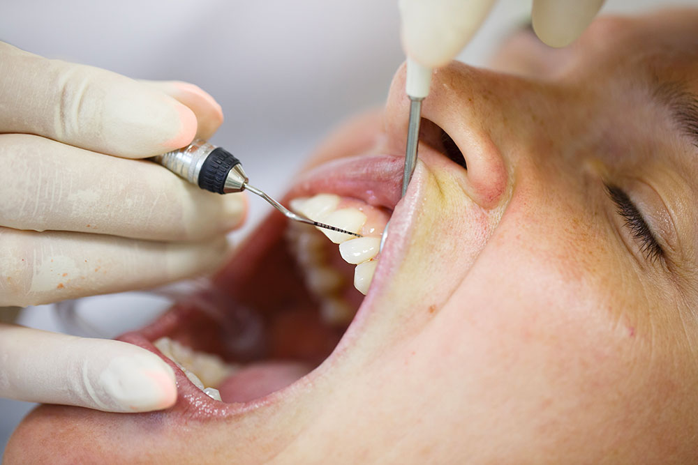 Assainissement parodontal - Cabinet dentaire Dr Ephraim Fareau - Chirurgien dentiste Haguenau - Dentiste Haguenau