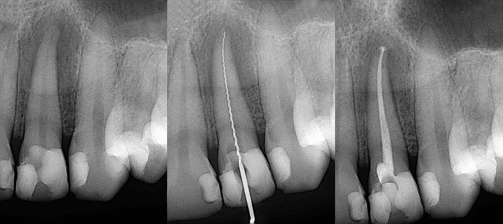 Endodontie - Cabinet dentaire Dr Ephraim Fareau - Chirurgien dentiste Haguenau - Dentiste Haguenau