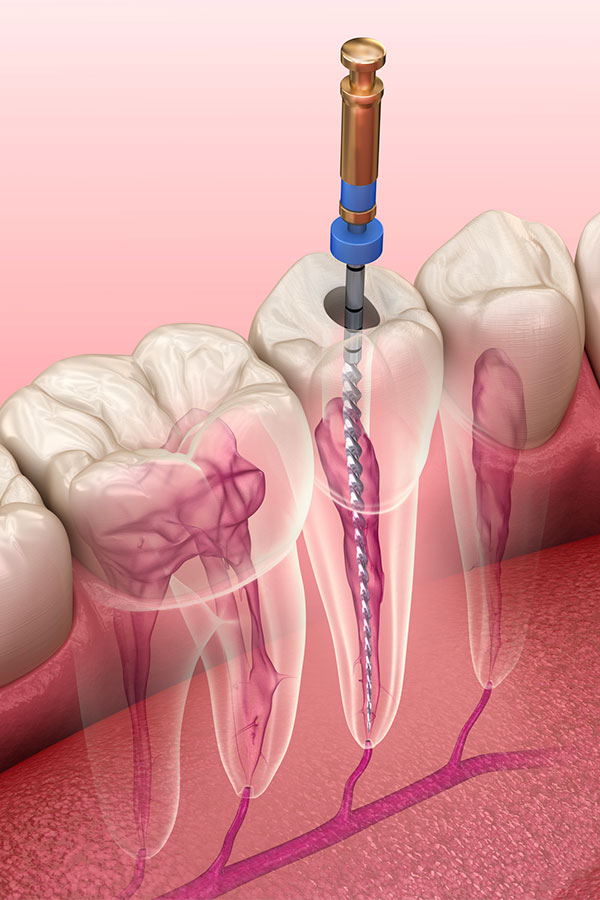 Endodontie - Cabinet dentaire Dr Ephraim Fareau - Chirurgien dentiste Haguenau - Dentiste Haguenau