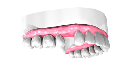 Implant dentaire - Cabinet dentaire Dr Ephraim Fareau - Chirurgien dentiste Haguenau - Dentiste Haguenau