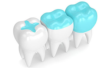 Inlay onlay - Cabinet dentaire Dr Ephraim Fareau - Chirurgien dentiste Haguenau - Dentiste Haguenau