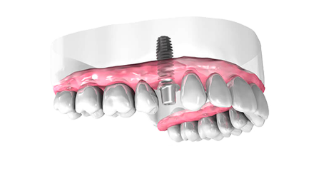 Implant dentaire - Cabinet dentaire Dr Ephraim Fareau - Chirurgien dentiste Haguenau - Dentiste Haguenau