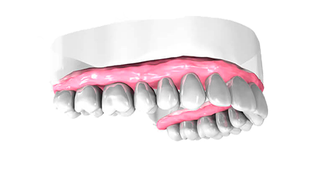 Implant dentaire - Cabinet dentaire Dr Ephraim Fareau - Chirurgien dentiste Haguenau - Dentiste Haguenau