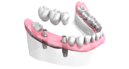 Implant dentaire - Cabinet dentaire Dr Ephraim Fareau - Chirurgien dentiste Haguenau - Dentiste Haguenau
