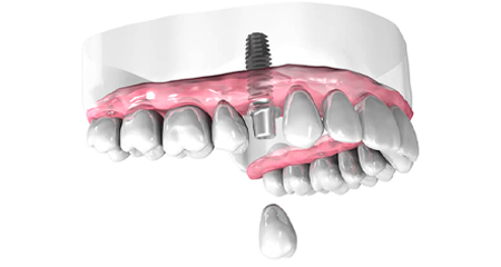 Implant dentaire - Cabinet dentaire Dr Ephraim Fareau - Chirurgien dentiste Haguenau - Dentiste Haguenau