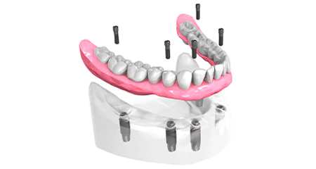 Implant dentaire - Cabinet dentaire Dr Ephraim Fareau - Chirurgien dentiste Haguenau - Dentiste Haguenau