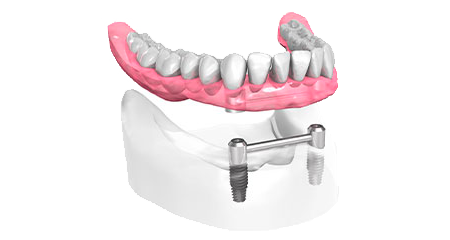 Implant dentaire - Cabinet dentaire Dr Ephraim Fareau - Chirurgien dentiste Haguenau - Dentiste Haguenau