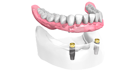 Implant dentaire - Cabinet dentaire Dr Ephraim Fareau - Chirurgien dentiste Haguenau - Dentiste Haguenau